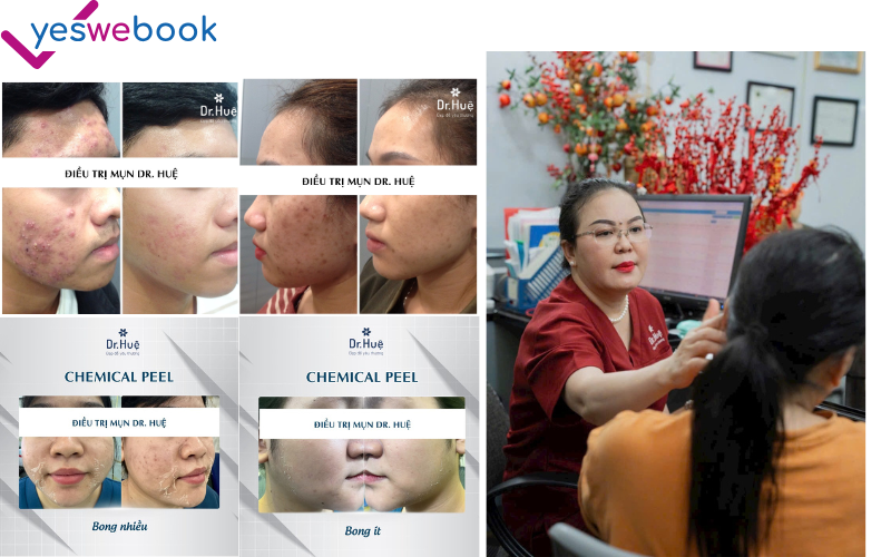 trị mụn uy tín Dr. Huệ Clinic & Spa